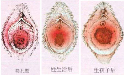 性刺激下，陰道被反復擴張會變長嗎