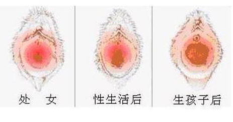 科普圖解：處女膜在陰道什麼位置